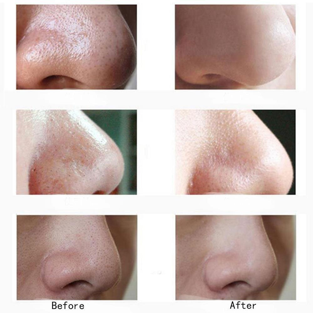 Blackhead Remover Face Acne Black Pimple